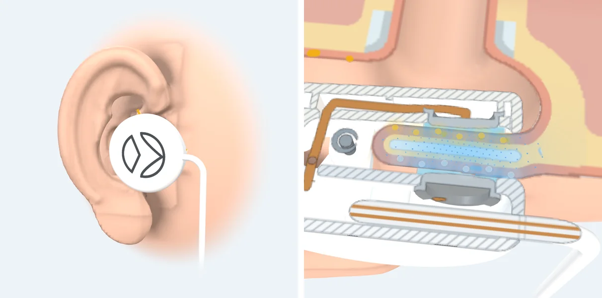 A 3D ear wearing the white Vagal clip on the tragus, beside a cut through the tragus with current flowing between the two pads